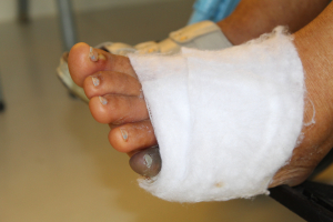 Hospital Marcelino V&eacute;lez disminuye niveles de amputaci&oacute;n por pie diab&eacute;tico